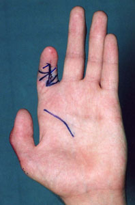 послеоперационная контрактура пальца