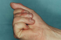 результат пересадки сустава пальца