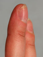 энходрома пальца после операции